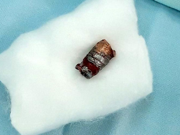 Thanh niên dùng súng bút bắn bạn của anh trai