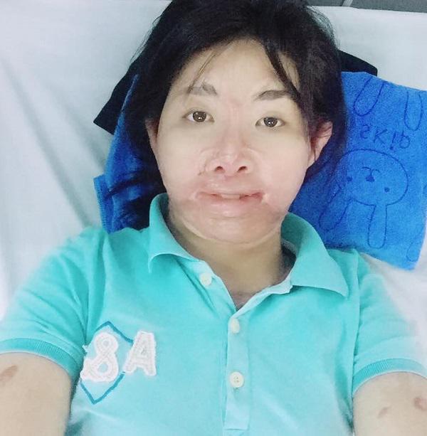 Sau 700 ngày bị chồng tẩm xăng đốt, người mẹ từng rất xinh đẹp đếm ngược để được gặp con