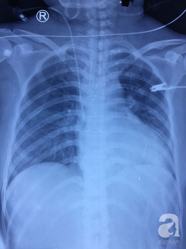 Long An: Đột nhập nhà dân nhưng bị phát hiện, tên cướp đâm thủng tim gan người phụ nữ