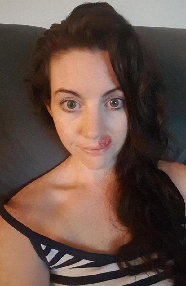 Chỉ 1 nốt mụn nhỏ xuất hiện trên mặt, cô gái trẻ bị chẩn đoán mắc bệnh nguy hiểm