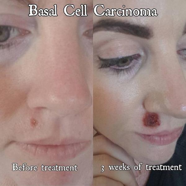 Chỉ 1 nốt mụn nhỏ xuất hiện trên mặt, cô gái trẻ bị chẩn đoán mắc bệnh nguy hiểm