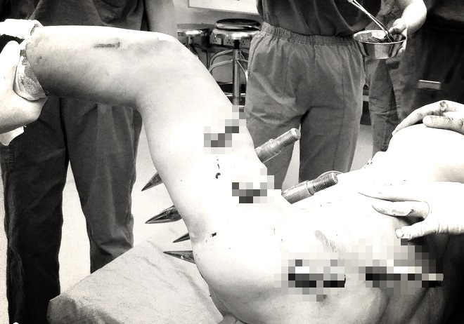 Robot trong nhà máy gặp trục trặc kỹ thuật, đâm 10 chiếc đinh tán xuyên người công nhân