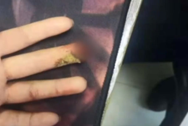 Bé gái 9 tuổi phải cưa ngón tay vì cách sơ cứu sai lầm của bà nội sau khi bị kẹt tay vào cửa