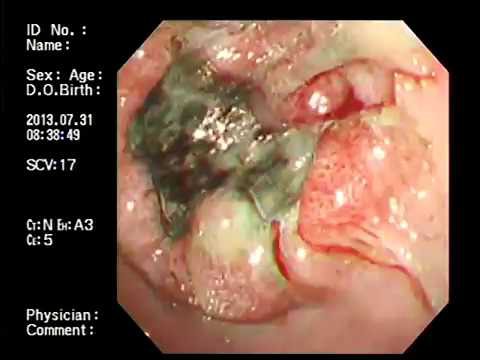 Đau vị trí này cảnh báo ung thư dạ dày cần đi kiểm tra ngay