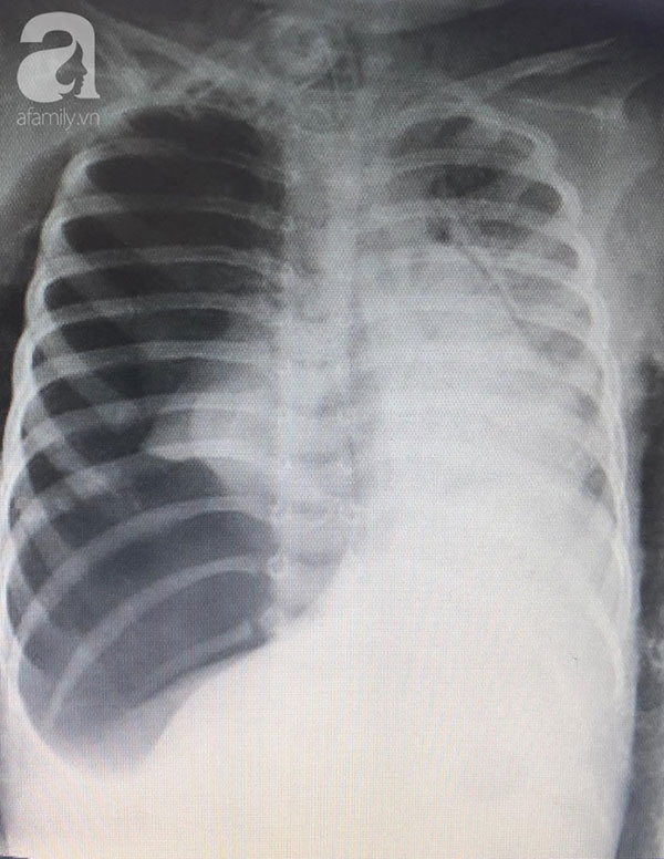 Bé gái 3 tuổi ngưng tim, ngưng thở nguy kịch nhưng cha mẹ không biết con đã nuốt hạt mãng cầu