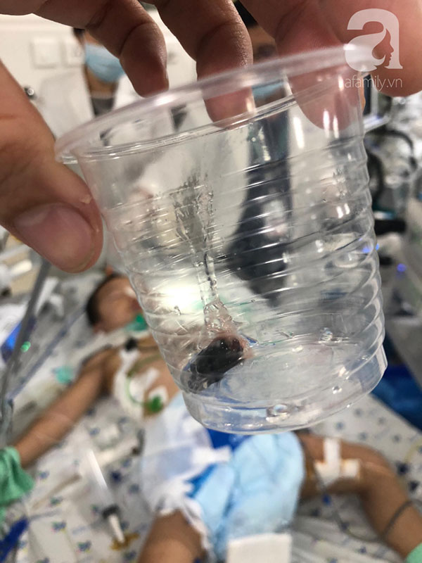 Bé gái 3 tuổi ngưng tim, ngưng thở nguy kịch nhưng cha mẹ không biết con đã nuốt hạt mãng cầu