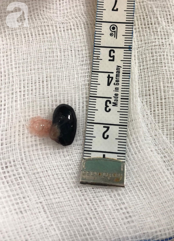 Bé gái 3 tuổi ngưng tim, ngưng thở nguy kịch nhưng cha mẹ không biết con đã nuốt hạt mãng cầu