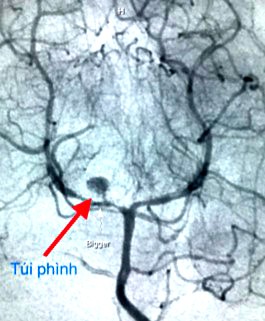 Cứu sống bệnh nhi 3 tuổi bị vỡ phình mạch não