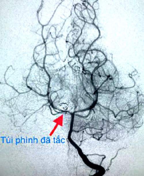 Cứu sống bệnh nhi 3 tuổi bị vỡ phình mạch não