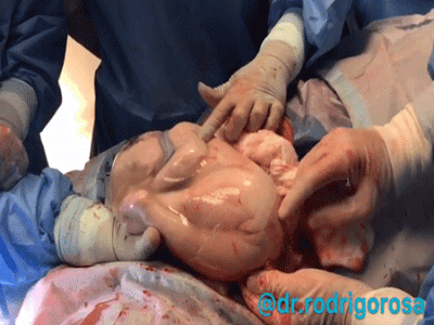 Chào đời nhưng em bé vẫn nằm ngủ ngon lành trong túi ối, mặc kệ thế giới mình vẫn đang buồn ngủ lắm