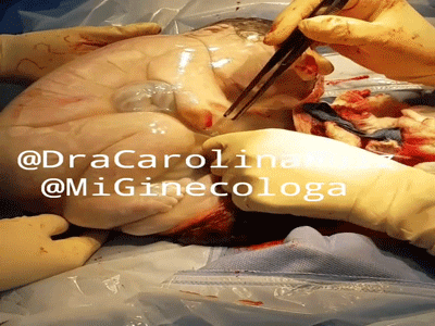 Chào đời nhưng em bé vẫn nằm ngủ ngon lành trong túi ối, mặc kệ thế giới mình vẫn đang buồn ngủ lắm