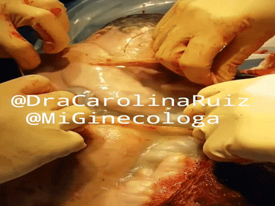 Chào đời nhưng em bé vẫn nằm ngủ ngon lành trong túi ối, mặc kệ thế giới mình vẫn đang buồn ngủ lắm