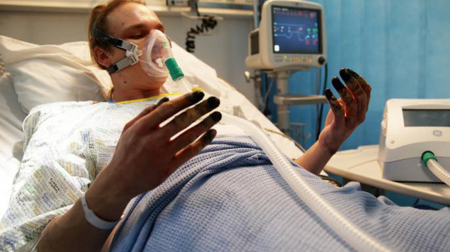 Dọn nhà, người phụ nữ bị hoại tử 8 ngón tay đen sì: Triệu chứng bất thường mọi người phải hết sức cảnh giác