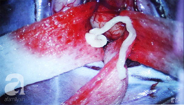 Cảnh báo: Ai hay ăn gỏi và rau sống, coi chừng bị ký sinh tấn công não nguy kịch như người đàn ông này