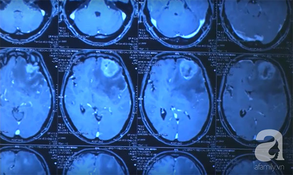 Cảnh báo: Ai hay ăn gỏi và rau sống, coi chừng bị ký sinh tấn công não nguy kịch như người đàn ông này