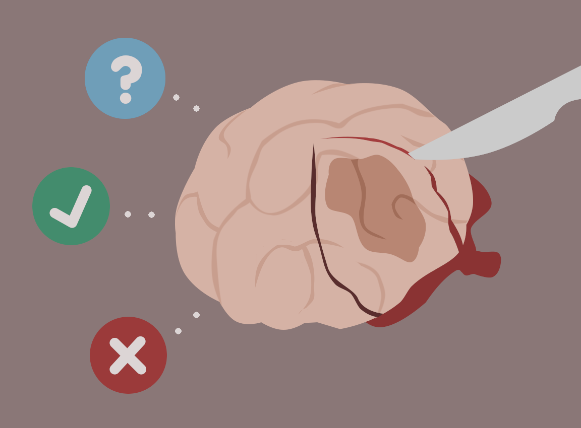 Mổ phanh não khi bệnh nhân vẫn đang tỉnh? Phương pháp nghe thì ghê rợn này ngày càng phổ biến và đây là lý do