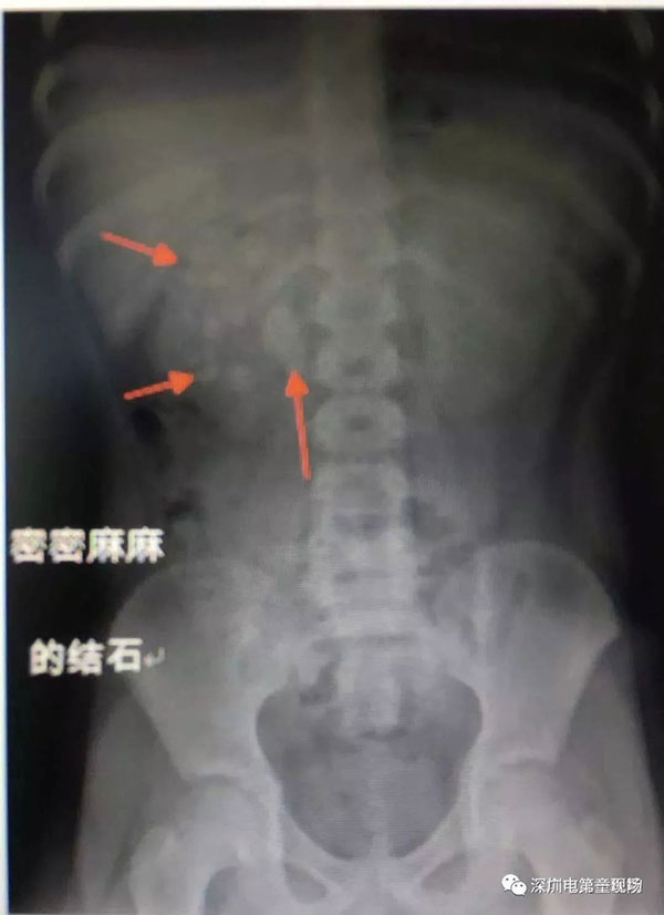 Cậu bé 9 tuổi có hơn 50 viên sỏi trong thận, nguyên nhân không ngờ là từ chính thói quen ăn uống này