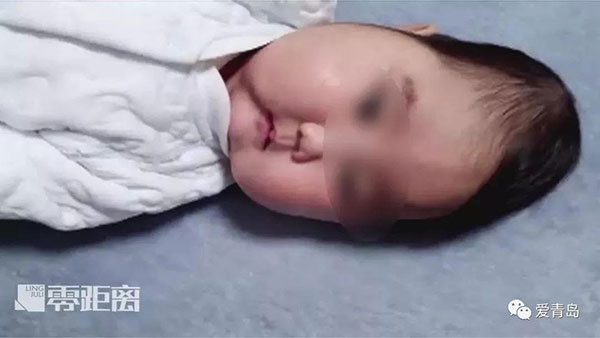 Tưởng con dậy thì sớm vì lông mày mọc rậm nhưng BS nói vấn đề còn nghiêm trọng hơn