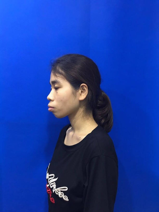 Bị chê ăn đu đủ không cần thìa, cô gái quyết tâm lột xác và thành quả bất ngờ khiến mẹ chỉ có thể nhận ra con gái qua vết sẹo