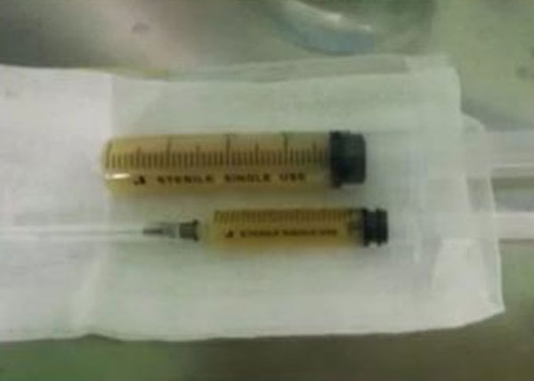 Con gái cảm sốt nhiều ngày, mẹ đưa đến bệnh viện thì phát hiện trong phổi có 600ml mủ và lời cảnh tỉnh về căn bệnh thường gặp ở trẻ