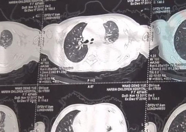 Con gái cảm sốt nhiều ngày, mẹ đưa đến bệnh viện thì phát hiện trong phổi có 600ml mủ và lời cảnh tỉnh về căn bệnh thường gặp ở trẻ