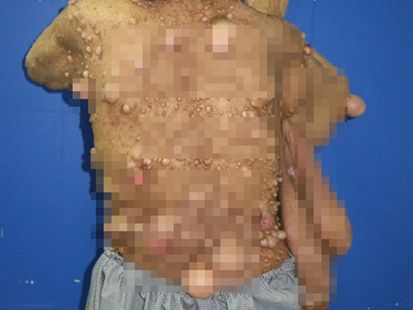 Người phụ nữ hơn 40 năm chung sống với hàng trăm khối u