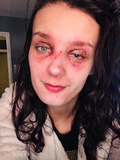 Hí hửng mở lò vi sóng, cô gái hứng trọn cú nổ kinh hoàng suýt mù mắt vì hành động nhiều người vô tư làm Hí hửng mở lò vi sóng, cô gái hứng trọn cú nổ kinh hoàng suýt mù mắt vì hành động nhiều người vô tư làm