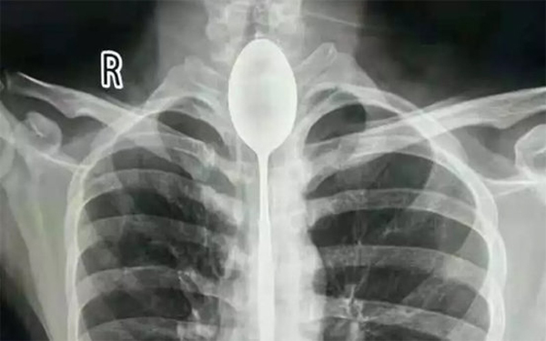 6 trường hợp y khoa kỳ lạ nhất 2018, hai người trong đó đã tử vong