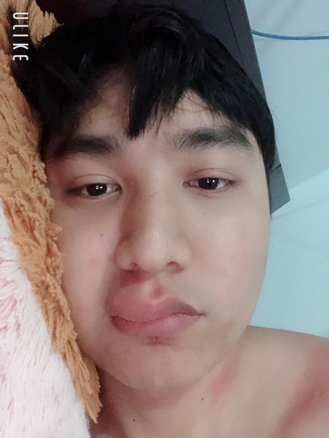 Kể khổ bị dị ứng thuốc, môi sưng tều đúng ngày đầu năm 2019, nam thanh niên lại được chú ý rần rần bởi nhan sắc thực sự phía sau