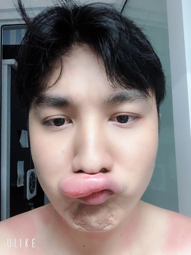 Kể khổ bị dị ứng thuốc, môi sưng tều đúng ngày đầu năm 2019, nam thanh niên lại được chú ý rần rần bởi nhan sắc thực sự phía sau