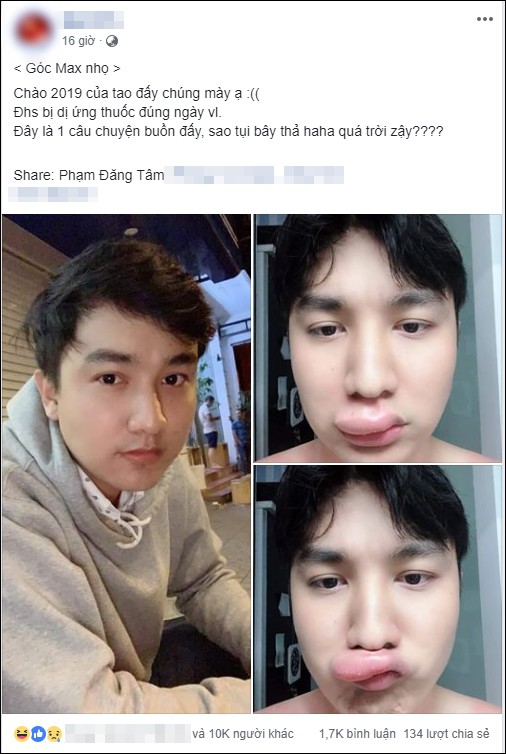 Kể khổ bị dị ứng thuốc, môi sưng tều đúng ngày đầu năm 2019, nam thanh niên lại được chú ý rần rần bởi nhan sắc thực sự phía sau