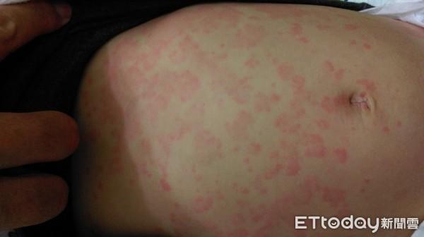 Người phụ nữ ngứa đến chảy máu da vì thường ăn thứ mà nhiều người thích khi trời lạnh