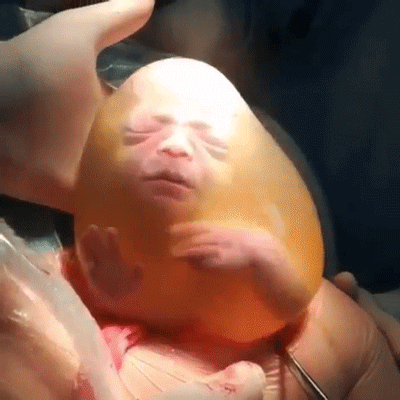 Biểu cảm đáng yêu của em bé sinh ra trong túi ối: Đây là đâu? Mình đã ra đời rồi ư?