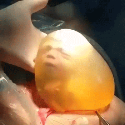 Biểu cảm đáng yêu của em bé sinh ra trong túi ối: Đây là đâu? Mình đã ra đời rồi ư?