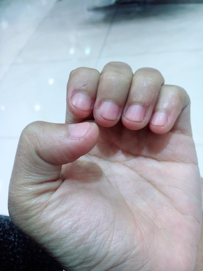 Có một kiểu người móng tay chẳng bao giờ nhú lên được vì cứ rảnh là ngồi cắn