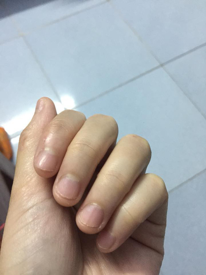 Có một kiểu người móng tay chẳng bao giờ nhú lên được vì cứ rảnh là ngồi cắn