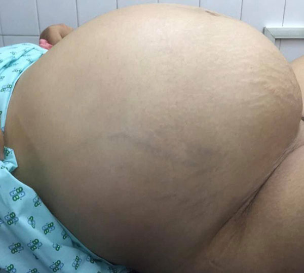 Từ 1 khối u nhỏ bị bỏ quên trong tử cung, 4 năm sau, người phụ nữ khổ sở vì khối u lớn khủng khiếp