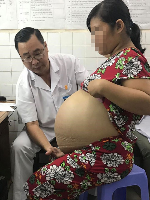 Từ 1 khối u nhỏ bị bỏ quên trong tử cung, 4 năm sau, người phụ nữ khổ sở vì khối u lớn khủng khiếp