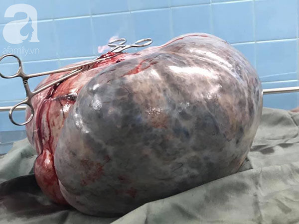 Từ 1 khối u nhỏ bị bỏ quên trong tử cung, 4 năm sau, người phụ nữ khổ sở vì khối u lớn khủng khiếp