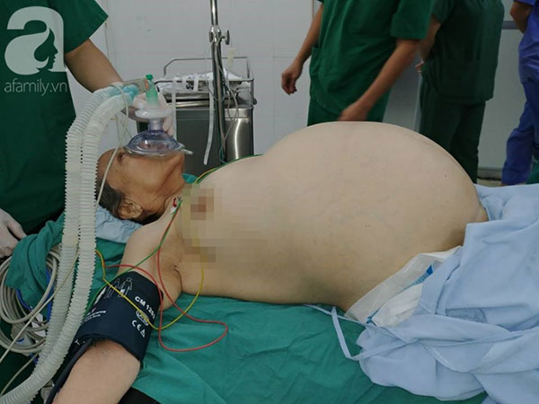 Từ 1 khối u nhỏ bị bỏ quên trong tử cung, 4 năm sau, người phụ nữ khổ sở vì khối u lớn khủng khiếp