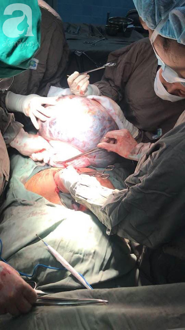 Từ 1 khối u nhỏ bị bỏ quên trong tử cung, 4 năm sau, người phụ nữ khổ sở vì khối u lớn khủng khiếp