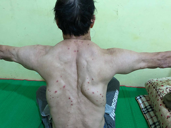 Uống rượu nhiều năm, 3 người đàn ông mắc bệnh lạ, khối u khủng mọc chi chít