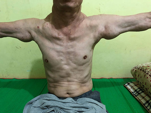 Uống rượu nhiều năm, 3 người đàn ông mắc bệnh lạ, khối u khủng mọc chi chít