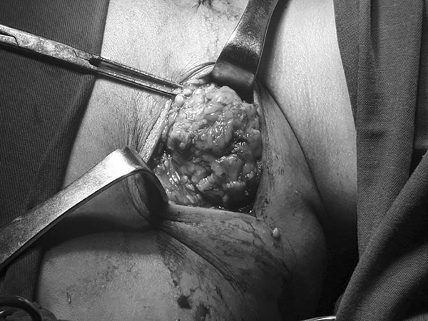 Uống rượu nhiều năm, 3 người đàn ông mắc bệnh lạ, khối u khủng mọc chi chít