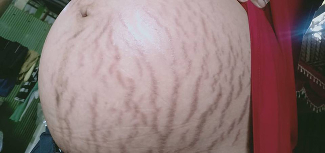 Sợ hãi chiếc bụng bầu rạn chằng chịt, vợ trẻ chia sẻ với chồng nhưng nhận được kết quả không ngờ...