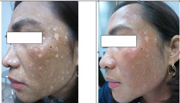 Đắp lá trầu không để được như da em bé, sau 3 năm mặt người phụ nữ như ngáo ộp