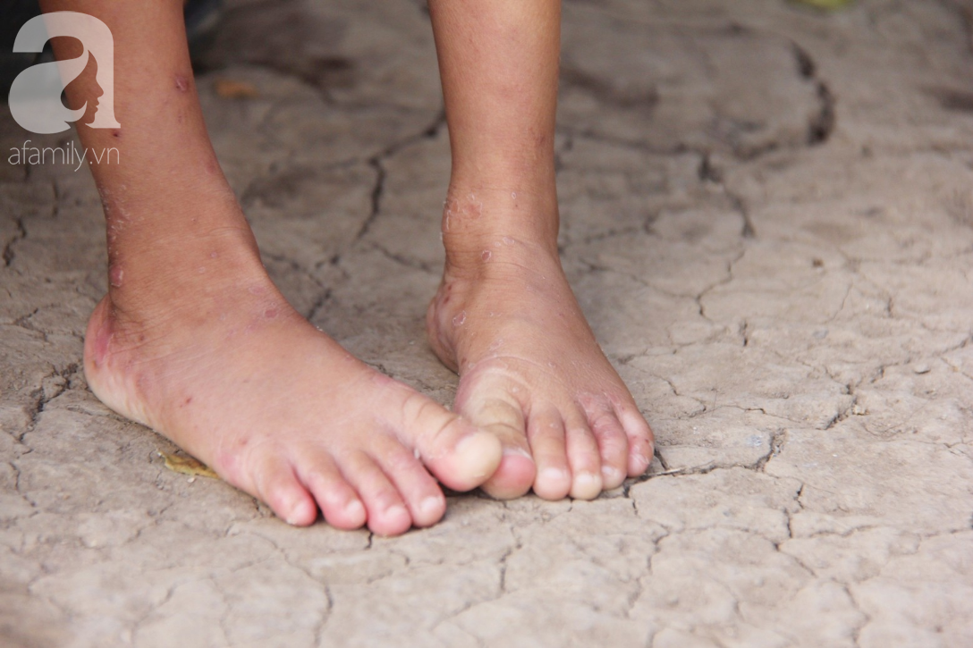 Lời khẩn cầu của người mẹ ôm con gái 2 tuổi bị hở van tim, chỉ nặng 6 ký mà không có tiền chạy chữa