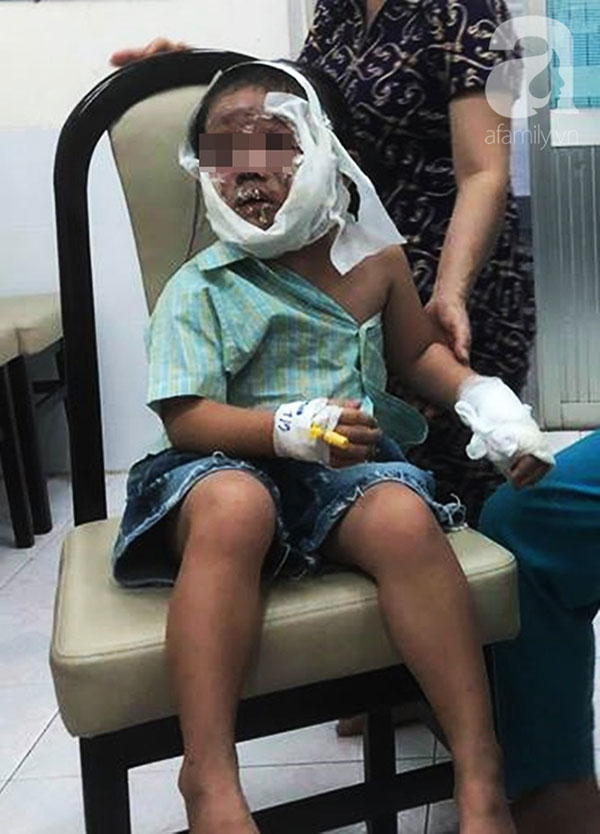 Lấy chai keo tạo kiểu tóc xịt vào bếp than, bé gái 6 tuổi bị lửa táp biến dạng mặt thương tâm