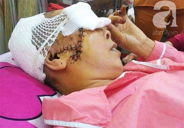 Theo con vào Bình Dương làm mướn, người phụ nữ bị máy kéo sợi bún lóc nát da đầu, cán thủng mắt thương tâm