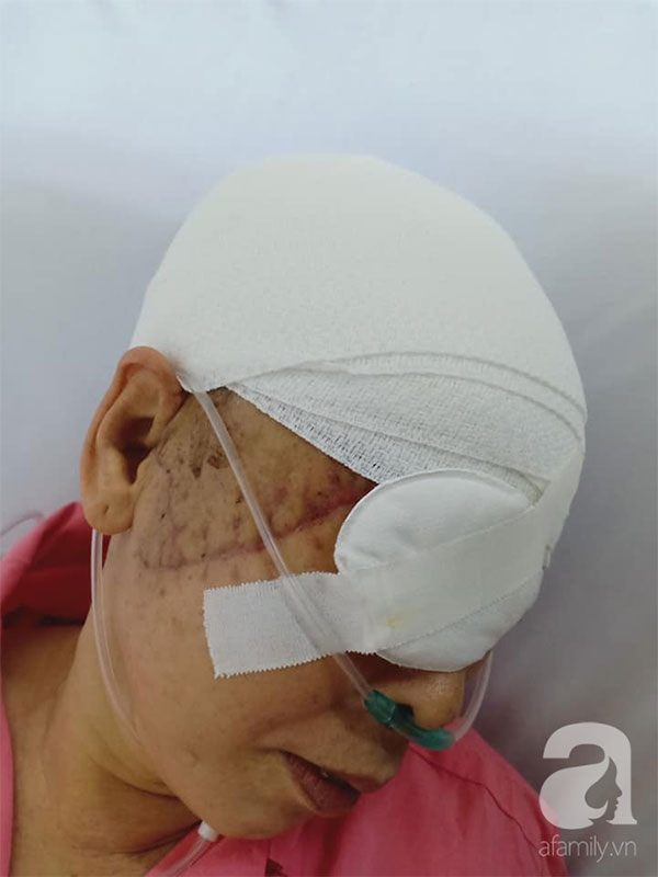 Theo con vào Bình Dương làm mướn, người phụ nữ bị máy kéo sợi bún lóc nát da đầu, cán thủng mắt thương tâm